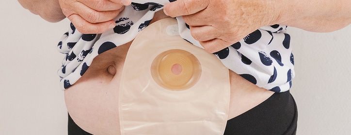 A photo of a bowel stoma bag